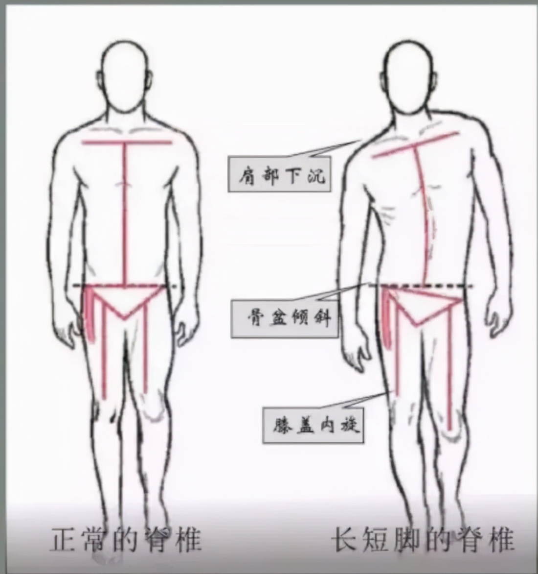 您所關(guān)心的正是我們關(guān)注的---兒童青少年脊柱側(cè)彎(圖2)