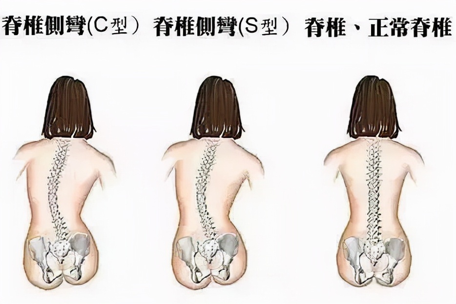 孩子脊椎變形的原因您知道多少？